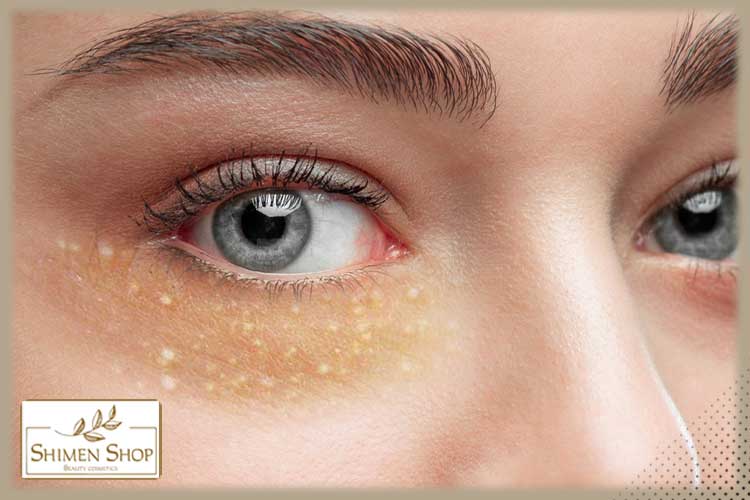 آیا کرم دور چشم باعث میلیا می‌شود؟