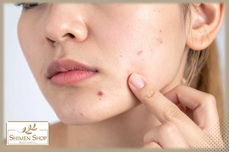 چرا جوش‌های دردناک به کرم ضد جوش نیاز دارند؟