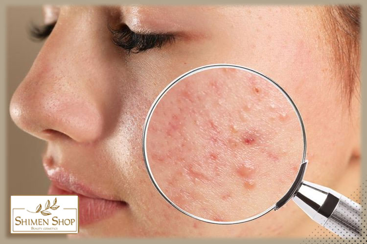بهترین روتین پوستی برای رفع جوش و آکنه