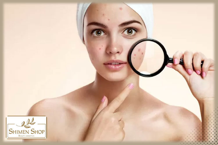 برای پیشگیری از آکنه چه کارهایی باید انجام دهیم؟