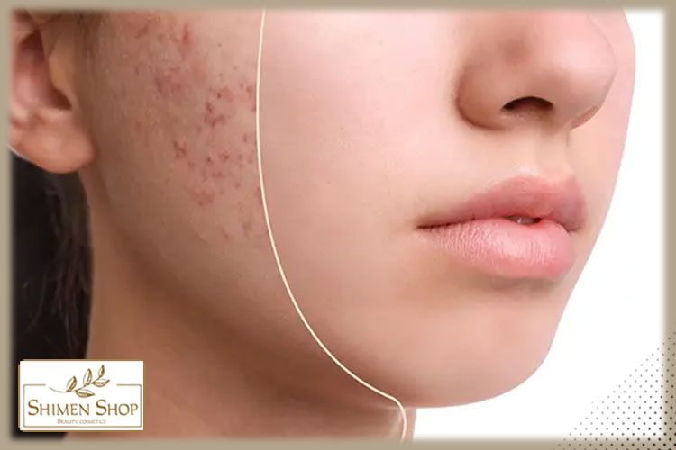 بهترین روش از بین بردن جای جوش
