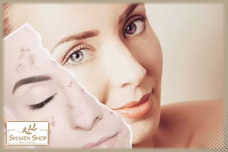چگونه ژل و کرم ضد جوش مناسب را انتخاب کنیم؟