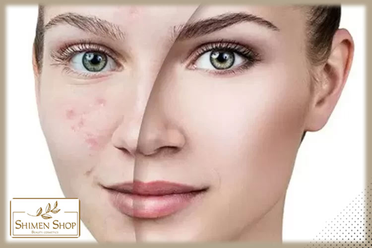 میلیا و آکنه چه تفاوتی دارند؟